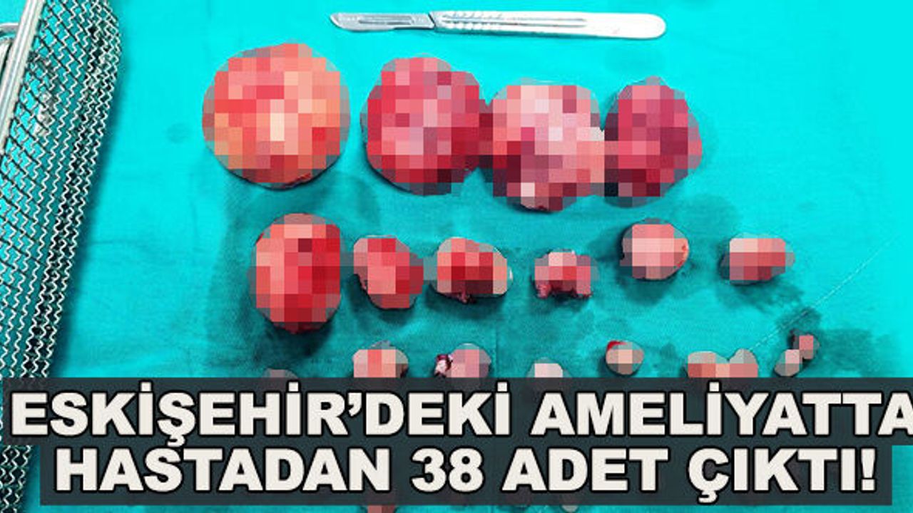 Eskişehir'deki ameliyatta hastadan 38 adet çıktı!